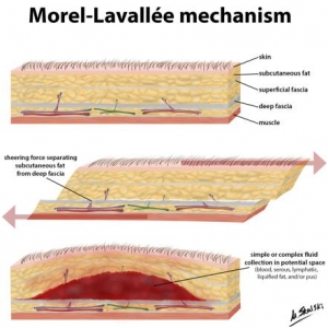 Morel-Lavallee Injury