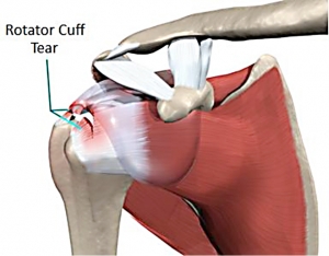 Rotator Cuff Surgery Personal Injury